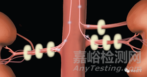 Paradise:超聲RDN產(chǎn)品IDE研究結(jié)果達到主要終點