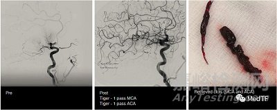 TIGERTRIEVER13：最小取栓支架獲FDA批準(zhǔn)上市
