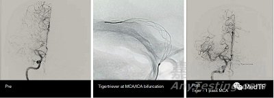 TIGERTRIEVER13：最小取栓支架獲FDA批準(zhǔn)上市