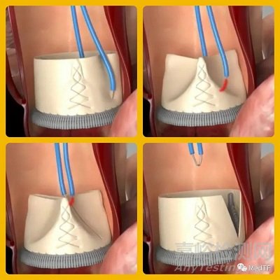 ShortCut：有效預(yù)防TAVR術(shù)引發(fā)冠狀動(dòng)脈閉塞