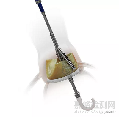 ShortCut：有效預(yù)防TAVR術(shù)引發(fā)冠狀動(dòng)脈閉塞