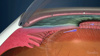 iStent infinite:青光眼引流產(chǎn)品獲FDA批準