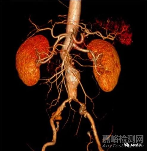 Aortoseal :具有縫合功能的EVAR覆膜支架