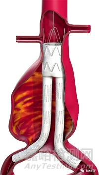 Aortoseal :具有縫合功能的EVAR覆膜支架