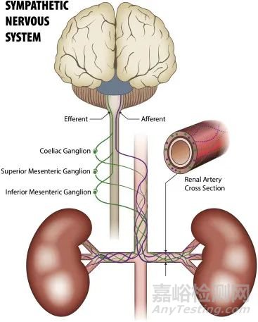 FDA突破性醫(yī)療器械魅麗緯葉經(jīng)導管去腎交感神經(jīng)術(shù)RDN設(shè)備技術(shù)與專利介紹