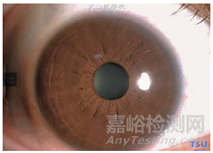 準(zhǔn)分子激光角膜屈光治療儀臨床試驗(yàn)設(shè)計(jì)思路