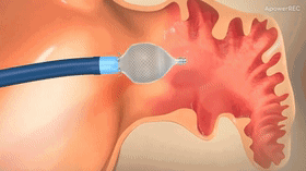 醫(yī)用鎳鈦合金原材料可制造高性能植入醫(yī)療器械，市場(chǎng)發(fā)展空間巨大