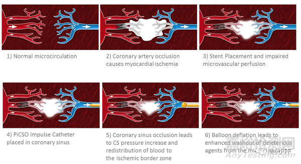 PiCSO:FDA批準(zhǔn)革命性急性心肌梗死進行IDE研究