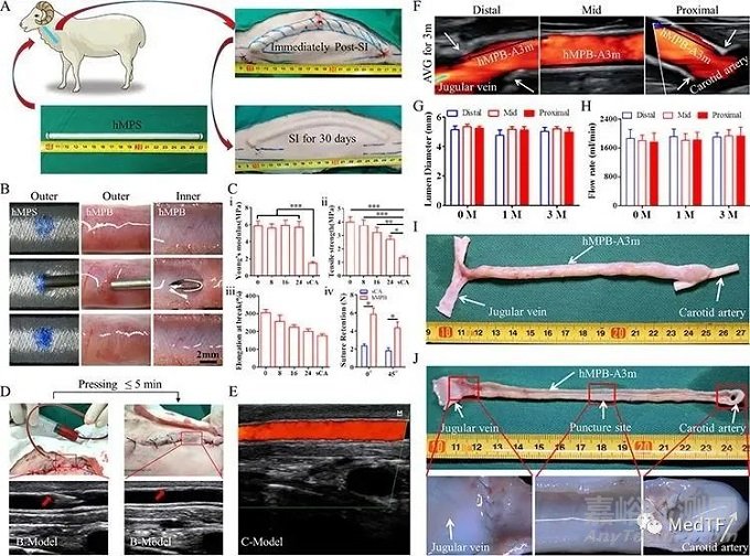 PULSSIBLE:生物型人工血管完成首例臨床入組