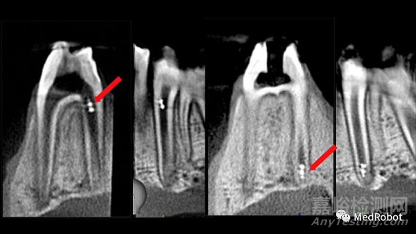 微型機(jī)器人技術(shù)應(yīng)用于牙髓治療診斷