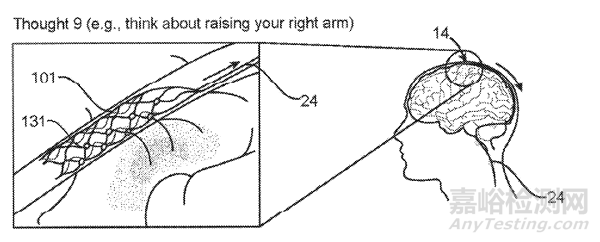 Synchron腦機(jī)接口技術(shù)與專利分析