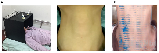 智能手機(jī)視頻運(yùn)動(dòng)分析可以檢測(cè)到頸動(dòng)脈狹窄