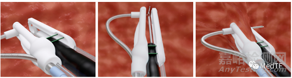 endomina:消化內(nèi)鏡下的減重手術(shù)