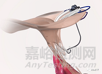 Mitral Butterfly:極具創(chuàng)意經(jīng)導管二尖瓣腱索修復