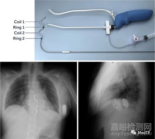 EV ICD：美敦力血管外ICD實現(xiàn)98.7%的除顫成功率