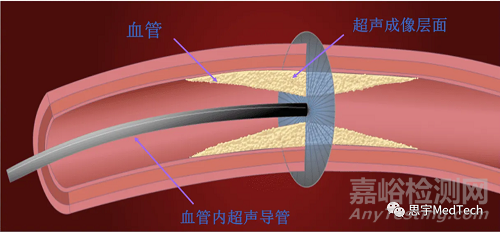 血管內(nèi)超聲的技術(shù)發(fā)展與代表產(chǎn)品