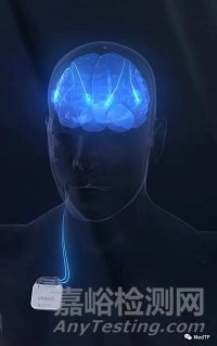 CNS：首個用于帕金森病、癲癇等腦功能疾病治療的植入式閉環(huán)腦刺激器