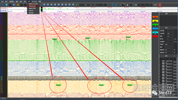 CNS：首個用于帕金森病、癲癇等腦功能疾病治療的植入式閉環(huán)腦刺激器