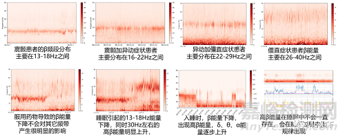 CNS：首個用于帕金森病、癲癇等腦功能疾病治療的植入式閉環(huán)腦刺激器