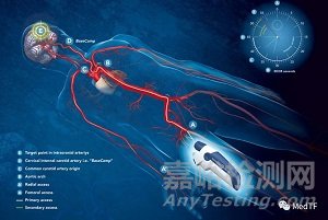 GECKO :具有電子導(dǎo)航功能的機(jī)電一體化導(dǎo)絲 神經(jīng)介入又一款神器