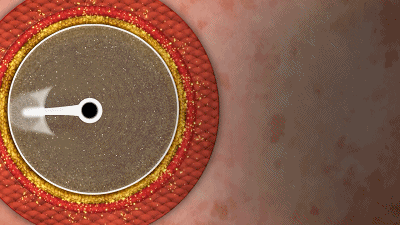 MagicTouch SCB:完成西羅莫司VS紫杉醇在小冠狀動脈頭對頭研究入組 PK貝朗