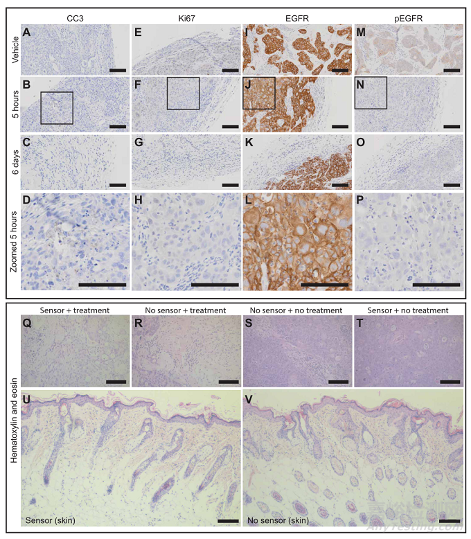 新型可穿戴設(shè)備可測(cè)量皮膚下腫瘤大小的變化
