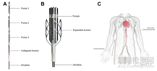 ModulHeart:首款允許疊加心臟泵公布FIM數(shù)據(jù)