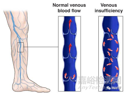 enVVe:經(jīng)導(dǎo)管靜脈瓣置換技術(shù)