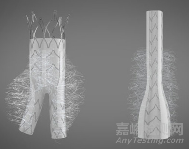 Kardiozis:帶絨毛的AAA覆膜支架 解決EVARⅡ型內漏