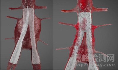 Kardiozis:帶絨毛的AAA覆膜支架 解決EVARⅡ型內漏