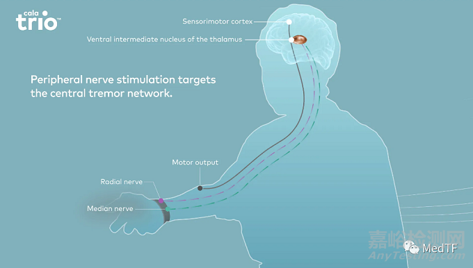 Cala Trio:真實(shí)世界研究證實(shí)有效減少震顫