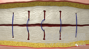 DURAMESH:全球唯一的網(wǎng)狀縫線 縫線二十年來最大創(chuàng)新