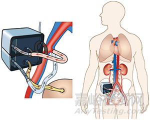 新型血液透析技術(shù)與代表產(chǎn)品
