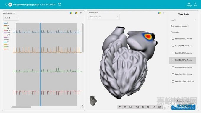 vMap:無(wú)創(chuàng)標(biāo)測(cè)技術(shù) 平均縮短1小時(shí)電生理消融時(shí)間