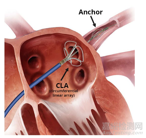 脈沖電場消融器械技術(shù)與專利分析