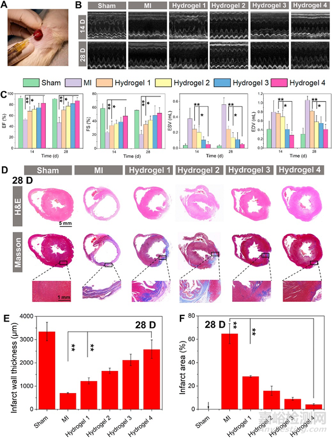 經(jīng)導(dǎo)管微創(chuàng)介入心衰治療可注射水凝膠研究取得新突破