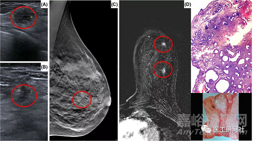 乳腺影像診斷設(shè)備及新技術(shù)進(jìn)展