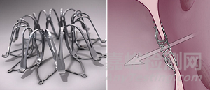 PReduction：心臟泵治療HFpEF 無需房間隔造孔