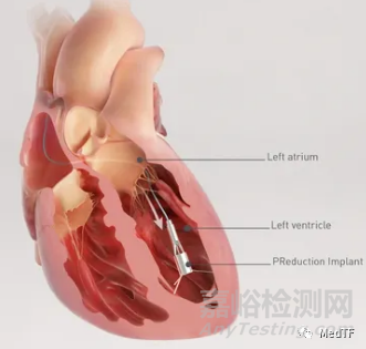 PReduction：心臟泵治療HFpEF 無需房間隔造孔