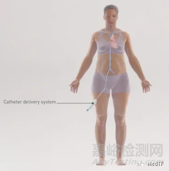 PReduction：心臟泵治療HFpEF 無需房間隔造孔