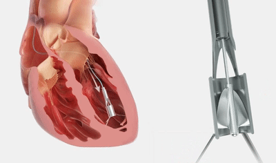 PReduction：心臟泵治療HFpEF 無需房間隔造孔