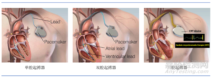 植入式心臟起搏器技術(shù)發(fā)展趨勢(shì)