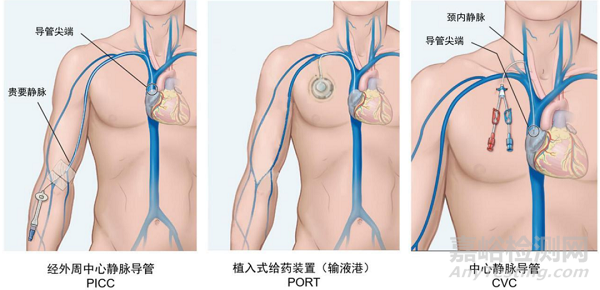 血管通路醫(yī)療器械市場情況和發(fā)展趨勢