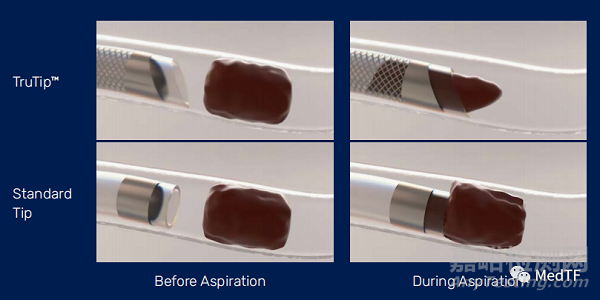Prodigy：無需溶栓藥物 單次清除血栓
