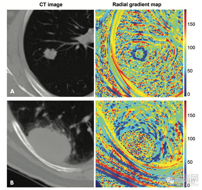 Radiology:影像組學(xué)特征的生物學(xué)意義