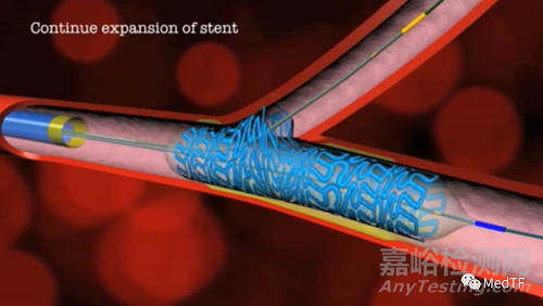 ABS:分叉的冠脈支架