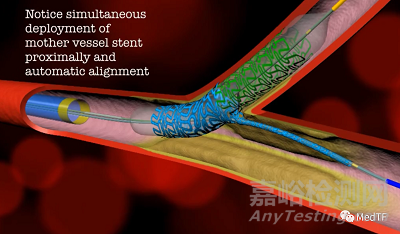 ABS:分叉的冠脈支架