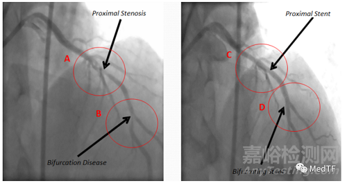 ABS:分叉的冠脈支架