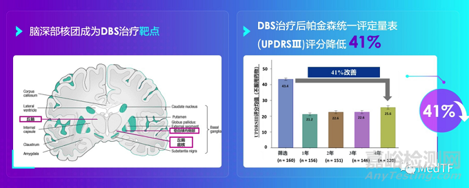 Vercise Genus:電刺激方向可控的腦起搏器