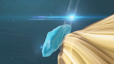 Vercise Genus:電刺激方向可控的腦起搏器